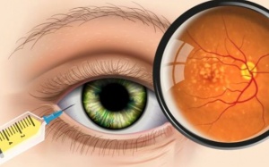 Bệnh viện nào ở Hà Nội tiêm nội nhãn võng mạc đái tháo đường?