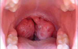 Viêm amidan quá phát ở trẻ và những biến chứng nguy hiểm