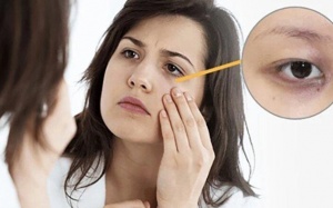 Uống ít nước có thể gây quầng thâm mắt