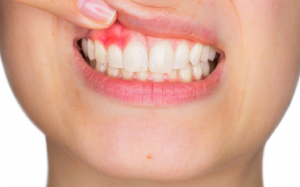 Chu kỳ kinh nguyệt ảnh hưởng thế nào tới sức khoẻ răng miệng?