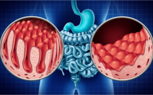 4 quan niệm sai lầm phổ biến về bệnh Celiac