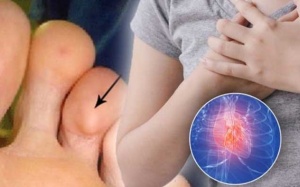 3 dấu hiệu ở bàn chân cảnh báo bệnh tim 