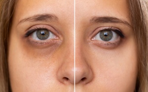 5 biểu hiện ở mắt cảnh báo sức khỏe gan