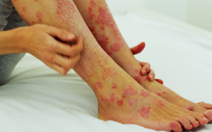 Phiền toái do bệnh vảy nến và giải pháp kiểm soát hiệu quả từ thảo dược