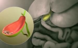 TPBVSK Kim Đởm Khang có bào mòn được sỏi mật 20mm không?