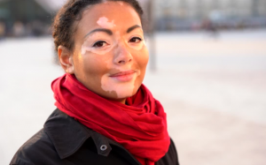 Lý giải nguyên nhân mắc bệnh bạch biến