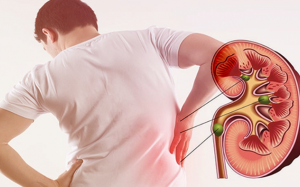 Nồng độ testosterone thấp làm tăng nguy cơ sỏi thận ở nam giới 