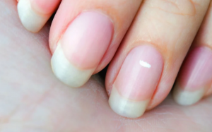 Đốm trắng xuất hiện trên móng tay do đâu?
