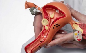 Nhân xơ tử cung 40mm là lớn hay nhỏ?