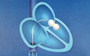 Nong van tim bằng bóng sống được bao lâu?