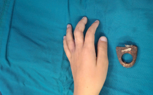 Bé 6 tuổi suýt hoại tử ngón tay vì vòng khoá cửa 