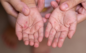 Cách phòng bệnh tay chân miệng mùa Hè