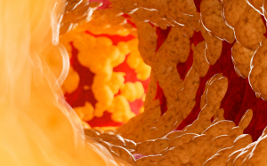 Làm cách nào để giảm mỡ máu hiệu quả?