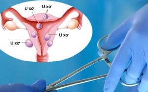 Nguyên nhân gây u xơ tử cung thường gặp