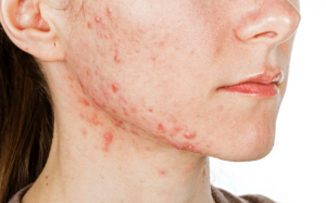 Ăn gì để giảm mụn nội tiết?