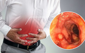 Phân biệt triệu chứng của viêm đại tràng và viêm loét đại tràng 