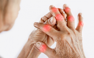 7 loại quả tốt cho người bệnh thấp khớp 