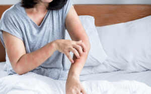 Mối liên hệ giữa viêm da dị ứng và rối loạn giấc ngủ 