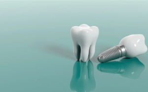 Khi nào nên thực hiện cấy ghép Implant cho răng?