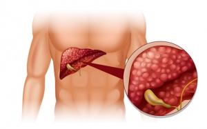 Chi phí tán sỏi mật qua da tại bệnh viện như thế nào?