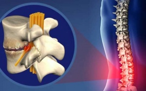 Hiểu về các giai đoạn thoái hóa cột sống