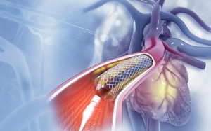 Đặt stent rồi có tránh được nhồi máu cơ tim không?
