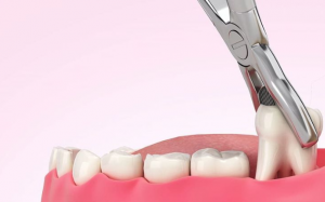 Những lầm tưởng phổ biến sau khi nhổ răng khôn 