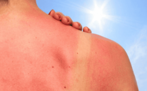 5 loại thực phẩm giúp phục hồi da cháy nắng 