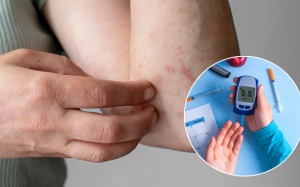 Người bệnh đái tháo đường bị ngứa da, càng gãi càng ngứa có nguy hiểm không?