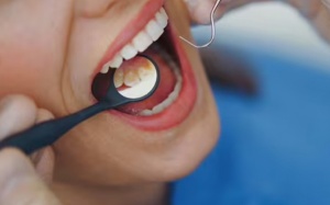 Dấu hiệu ở miệng có thể cảnh báo bệnh tim