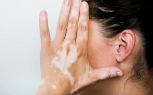 Những điều cần biết về bệnh bạch biến