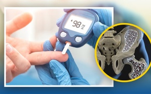 Đái tháo đường và loãng xương có mối liên hệ gì?