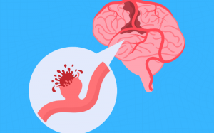 Giải đáp: Tai biến mạch máu não có nguy hiểm không?