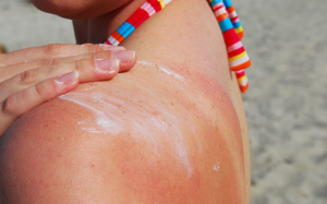 Phân biệt cháy nắng và ngộ độc ánh nắng mặt trời