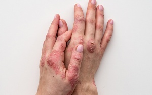 Vảy nến và nguy cơ viêm khớp: Những thông tin bạn cần biết