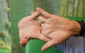 Thói quen bẻ khớp ngón tay có gây ra tình trạng viêm khớp?