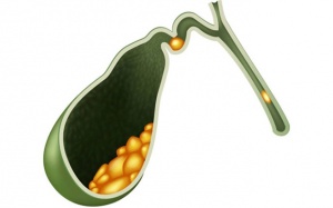 Sỏi cổ túi mật 10mm có nguy hiểm không?