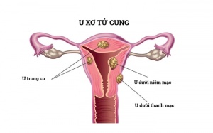 U xơ tử cung dưới thanh mạc là gì?