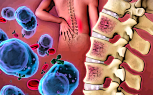 Lập bản đồ tủy xương: Hy vọng mới trong điều trị ung thư máu ác tính