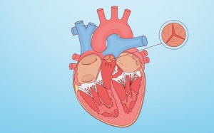 Hở van động mạch chủ 2/4, khó thở nên điều trị thế nào?