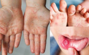Biến chứng thường gặp của bệnh tay chân miệng
