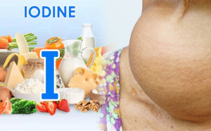 Đừng chủ quan với bướu cổ do thiếu iod