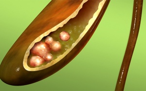 Sỏi túi mật hơn 8mm, uống thuốc Tây không đỡ có cần mổ không?