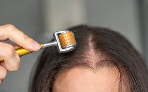 Đột phá công nghệ mở ra hy vọng cho người rụng tóc từng mảng