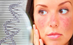 Yếu tố di truyền có ảnh hưởng đến bệnh lupus ban đỏ không?