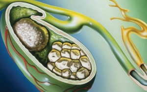 Có nhiều sỏi túi mật nhưng chưa đau, dùng TPBVSK Kim Đởm Khang bao lâu?