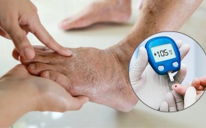 Mắc đái tháo đường, bị sưng 2 chân là biến chứng gì?