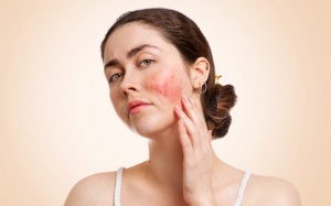 Lupus ban đỏ và ảnh hưởng đến sức khỏe toàn diện