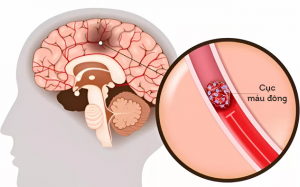 Tìm hiểu nguy cơ hình thành cục máu đông