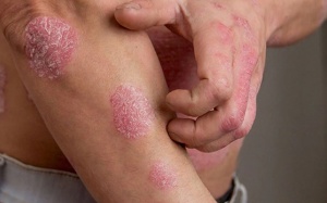 Ngày vảy nến thế giới: Nâng cao kiến thức cho người bệnh!